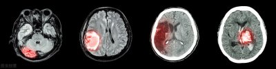 ​脑部ct能检查出什么症状（脑CT能查出脑溢血吗？怎么表现形式？还有其他的吗？