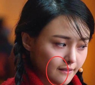 ​郑爽唇部脱毛，嘴角留下永久性疤痕，从此拍戏只能拍左脸