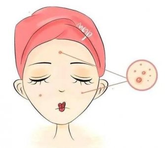 ​30岁满脸长痘痘是什么原因造成的