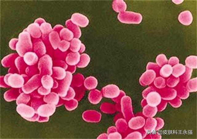 布病是什么病(布病是怎么传染的)(图1) 布病是什么病(布病是怎么传染的)(图1)