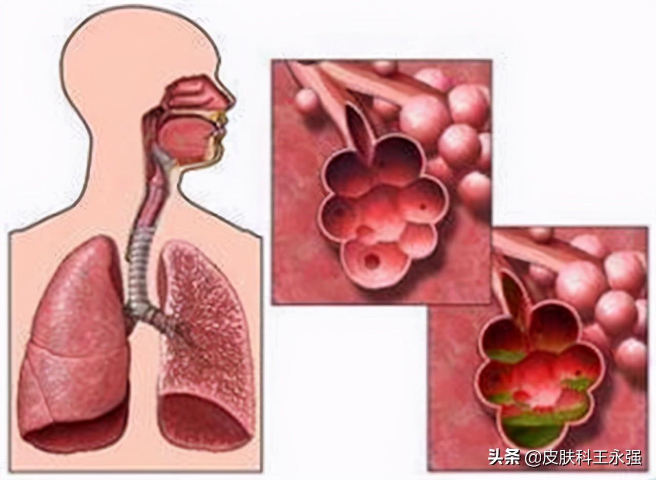 布病是什么病(布病是怎么传染的)(图3) 布病是什么病(布病是怎么传染的)(图3)