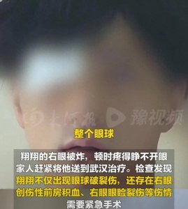​又一例！27岁小伙放冲天炮被炸伤，右眼球破裂失眠，已无复明希望