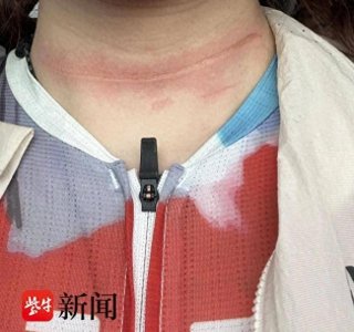 ​太突然！95后姑娘骑行比赛被风筝线“割喉”，伤口长约15厘米！
